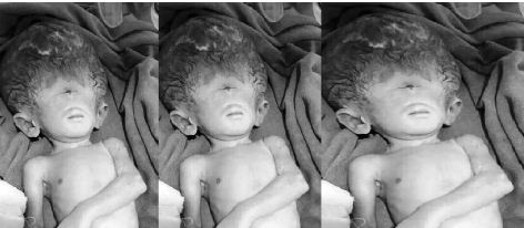 विराटनगरको नोबेल मेडिकल कलेजमा एउटा अनौठो बच्चाको जन्म